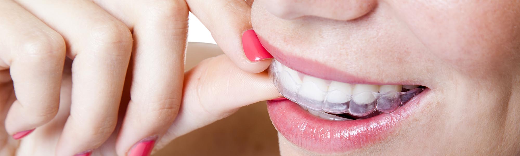 Invisalign® Downey CA