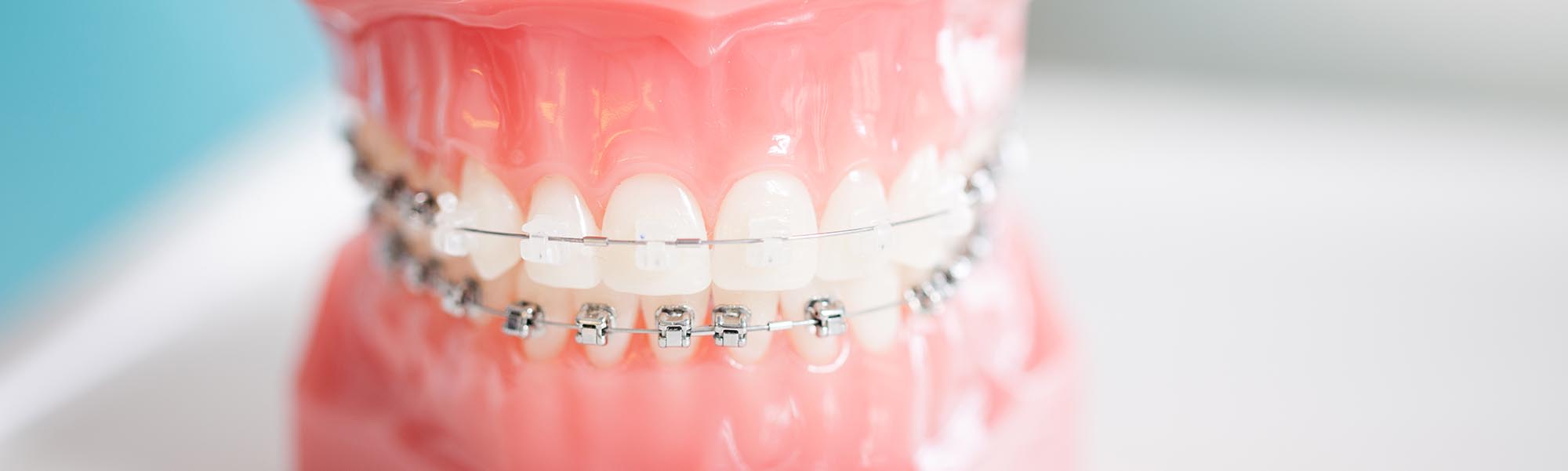 Metal Braces Downey CA