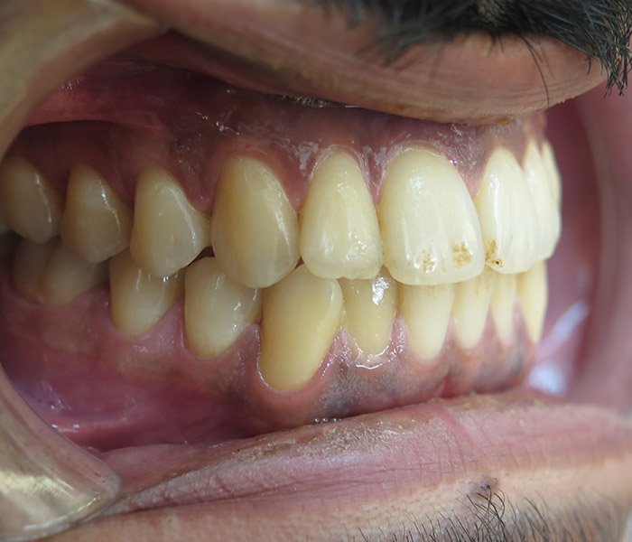 Before professional teeth cleaning – Downey Dental Arts