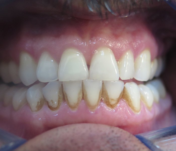 Before professional teeth cleaning – Downey Dental Arts