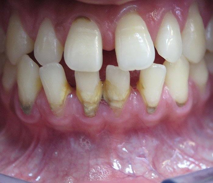 Before professional teeth cleaning – Downey Dental Arts