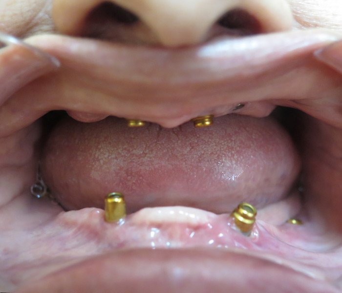 Before All-on-4 dental implants – Downey Dental Arts