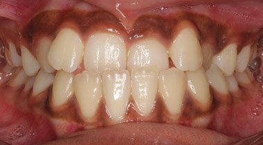 Before orthodontic treatment – Downey Dental Arts
