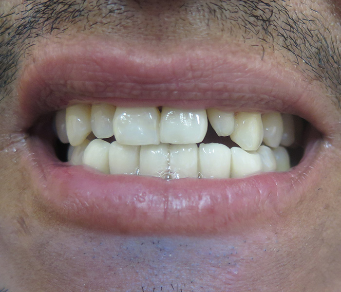 Before porcelain veneers – Downey Dental Arts