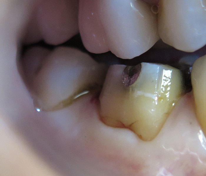 Before dental crown treatment – Downey Dental Arts