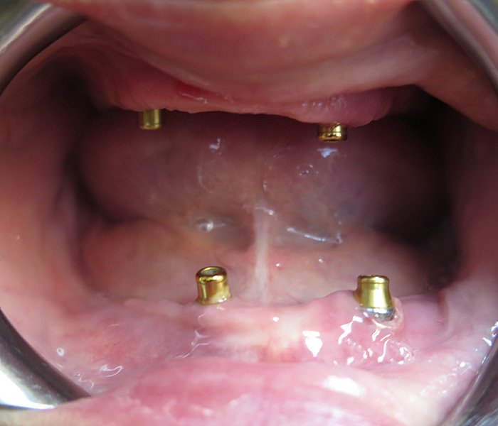 Before All-on-4 dental implants – Downey Dental Arts