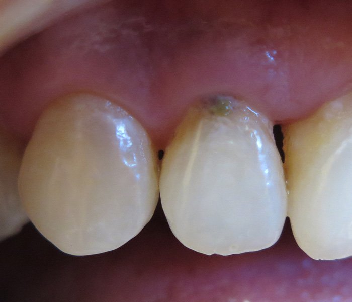 Before composite filling restoration – Downey Dental Arts