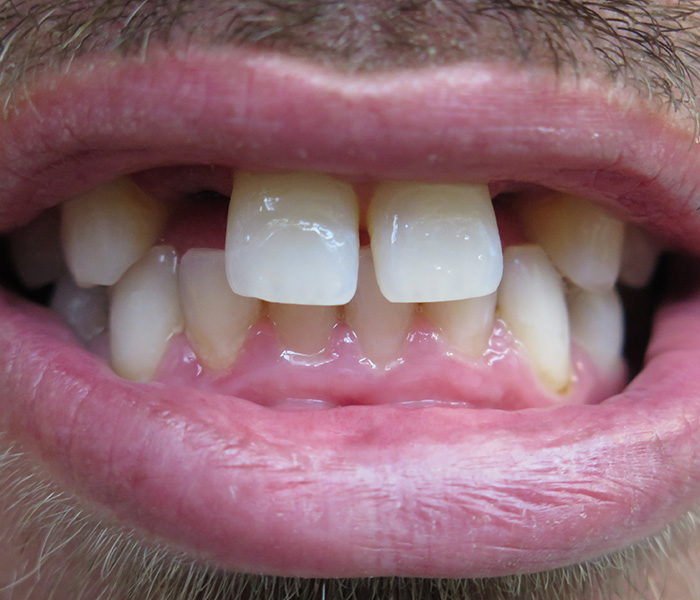 Before dental implant treatment – Downey Dental Arts