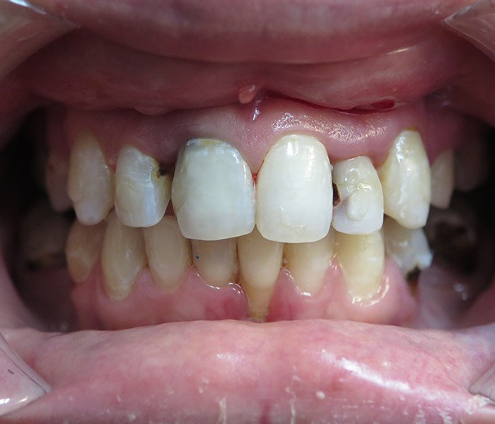 Before dental implant treatment – Downey Dental Arts