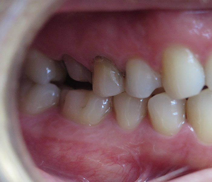 Before dental crown treatment – Downey Dental Arts