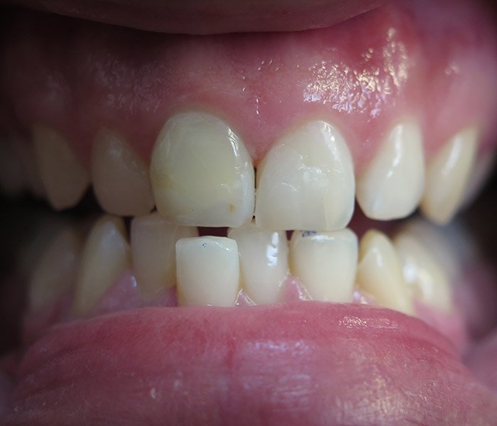 After composite filling restoration – Downey Dental Arts