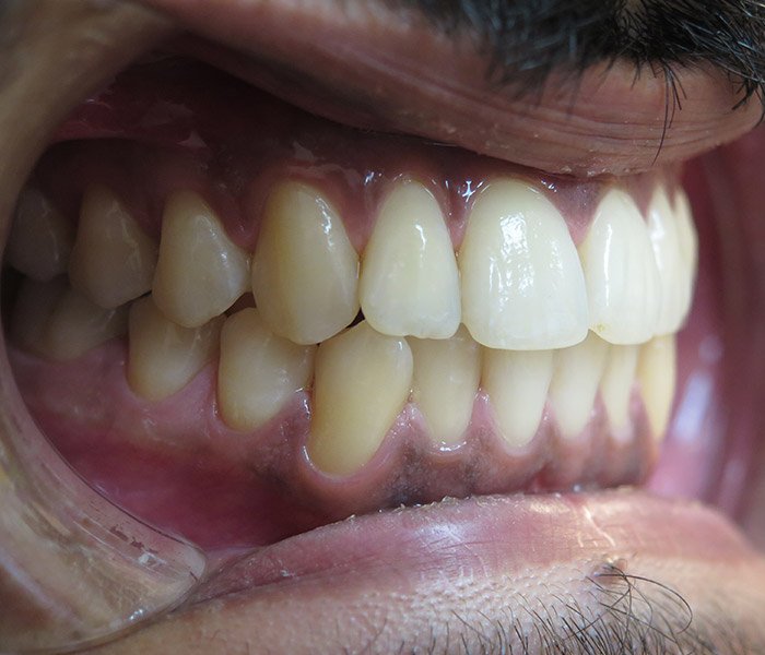 After professional teeth cleaning – Downey Dental Arts
