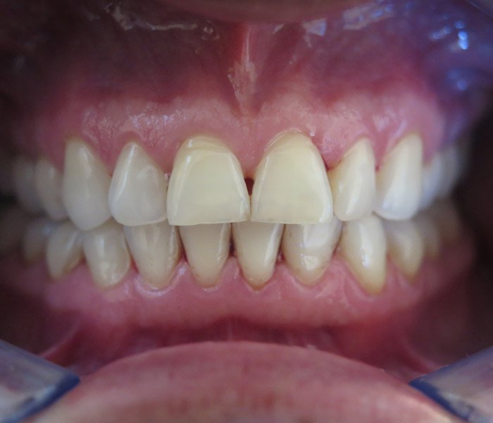 After professional teeth cleaning – Downey Dental Arts