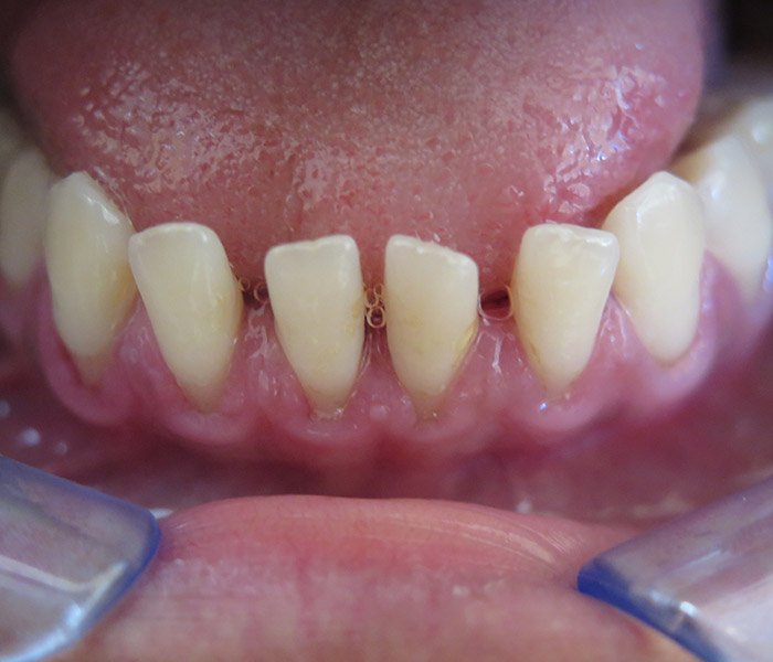 After professional teeth cleaning – Downey Dental Arts