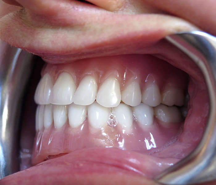 After All-on-4 dental implants – Downey Dental Arts