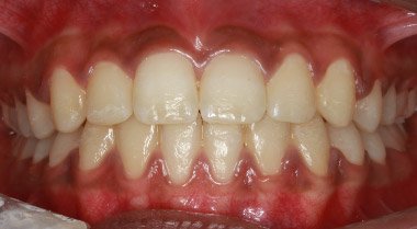 After orthodontic treatment – Downey Dental Arts