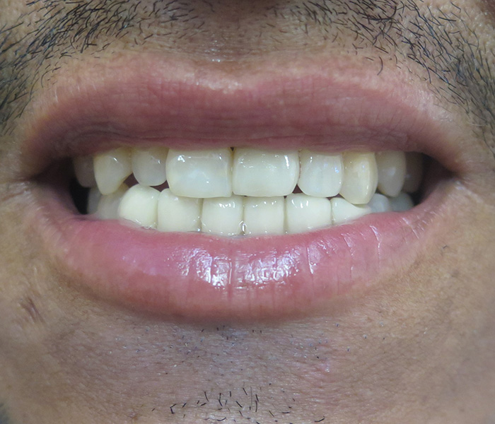 After porcelain veneers – Downey Dental Arts