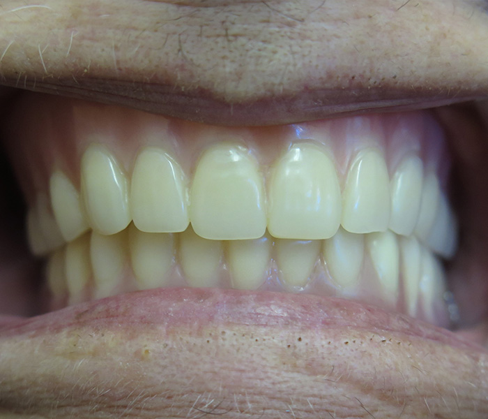 After All-on-4 dental implants – Downey Dental Arts