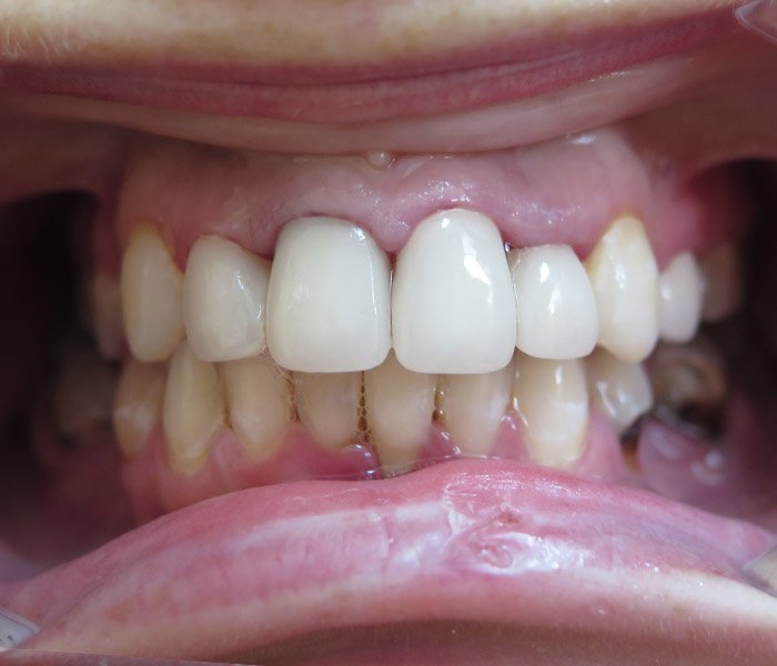 After dental implant treatment – Downey Dental Arts