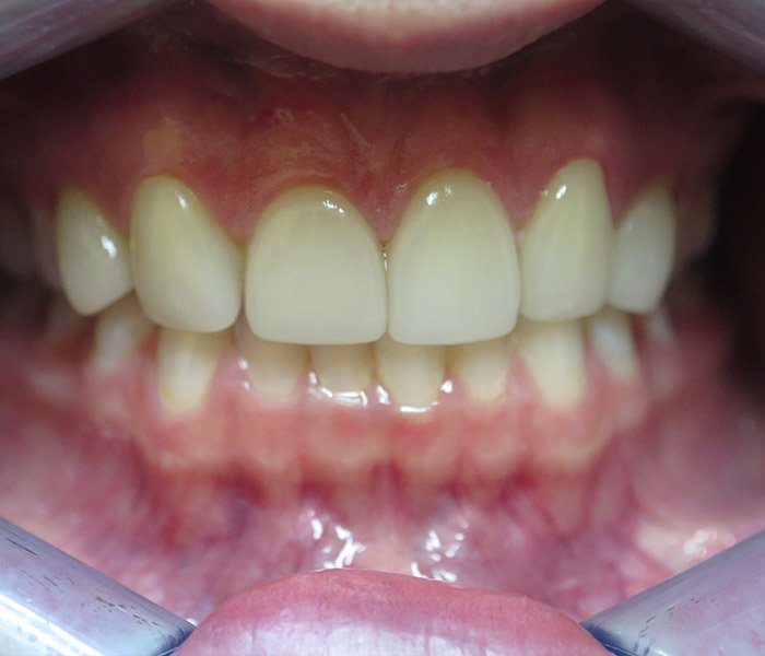 After porcelain veneers – Downey Dental Arts
