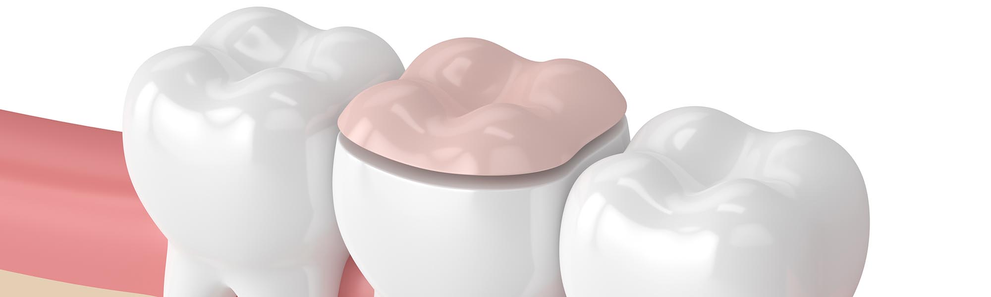 Restorative Inlays & Onlays Downey CA