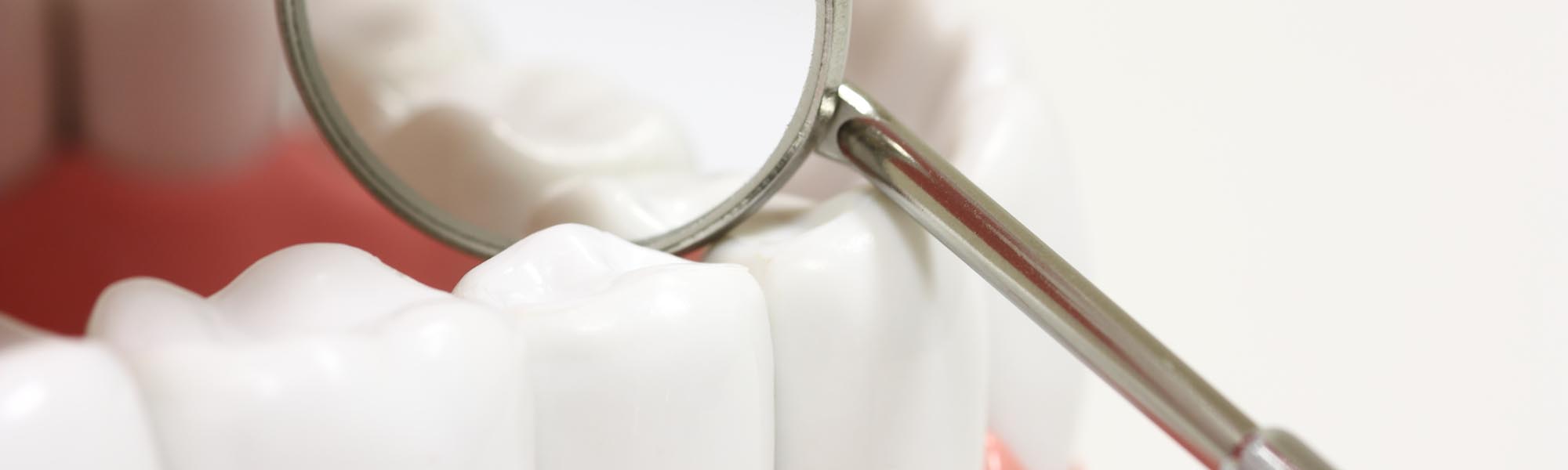 Restorative Inlays & Onlays in Downey CA