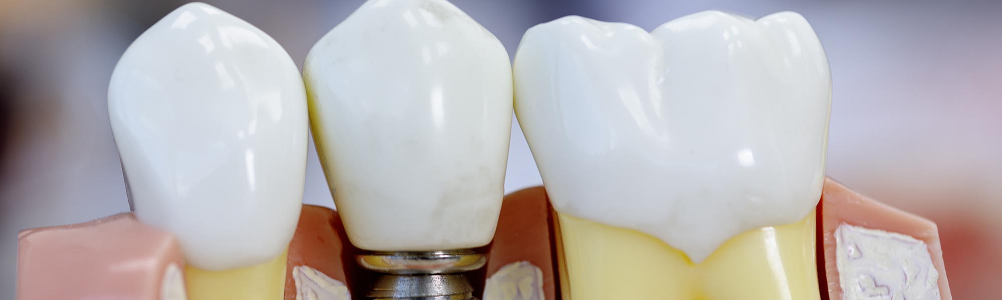 Single Tooth Implants Downey CA